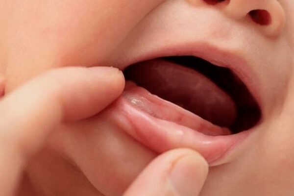 Trẻ mấy tháng mọc răng? Các dấu hiệu và thứ tự mọc răng ở trẻ